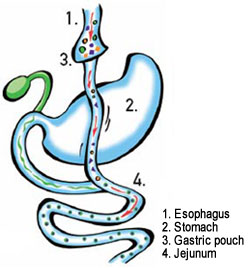 Gastric bypass surgery