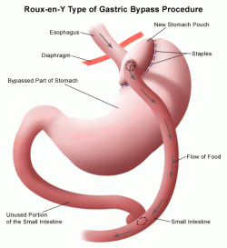 Roux-en-Y gastric bypass surgery