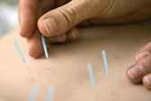 Acupuncture for weight loss